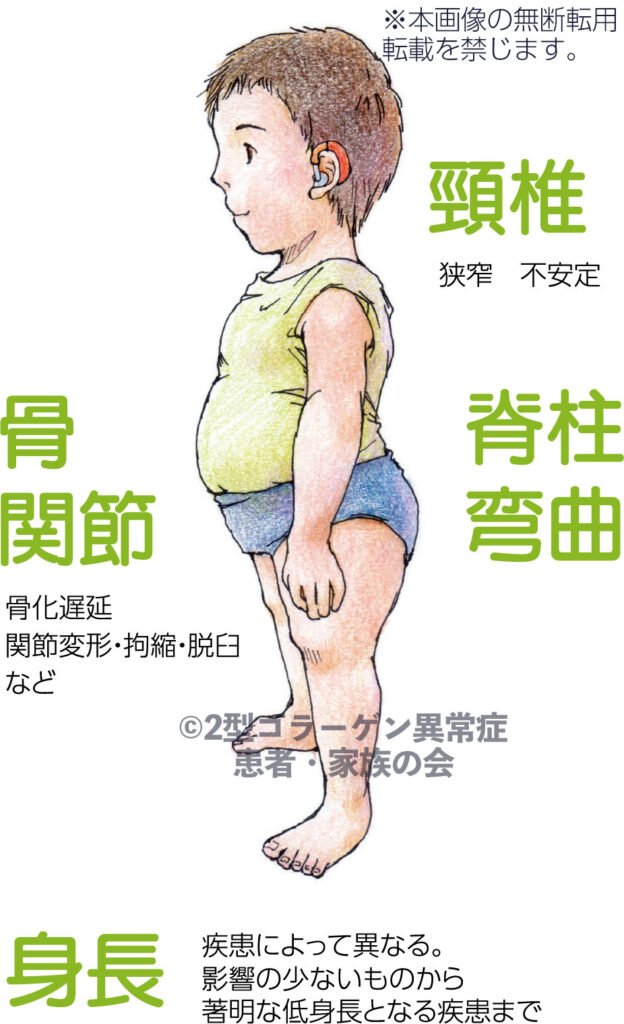 2型コラーゲン異常症関連疾患について - 2型コラーゲン異常症 患者・家族の会
