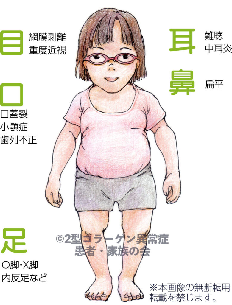 2型コラーゲン異常症関連疾患について - 2型コラーゲン異常症 患者・家族の会